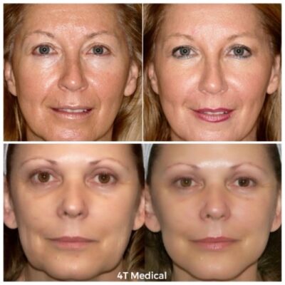ladies face after treatments