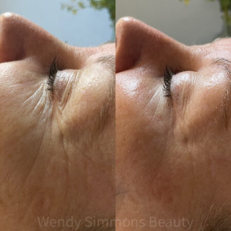 Close up of before and after treatment